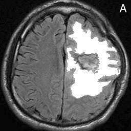 14 is detected tumor. 6. Tumor Region in Brain- In last step, intensity of region which is finally selected as tumor, is raised to highest intensity value. Fig. 15 is brain image with tumor.