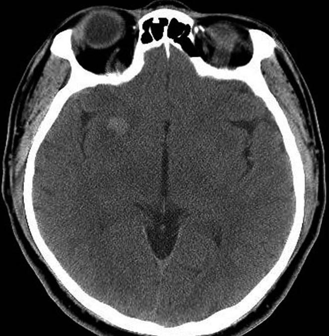 Thrombosed neurysm Mimicking rain Tumor tensity on T1-weighted images with peripheral