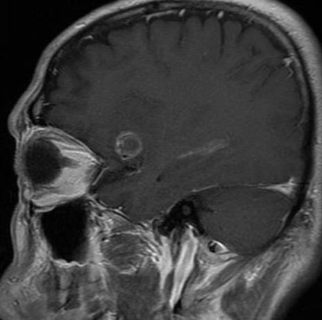 E: Gadolinium-enhanced T1-weighted axial MRI.