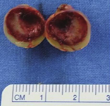 The patient recovered well and discharged a week later. DISCUSSION Fig. 4. Gross images of the removed mass. : Gross image of the mass shows yellowish slithery surface as a vessel wall.