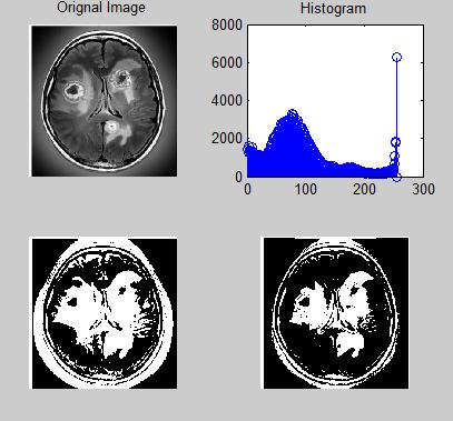 If the brain image has the tumor region, the further processing steps are needed to be done. The preprocessing step is important to segment the brain image.