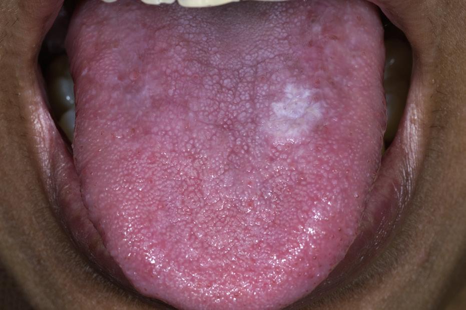 Fig. 1: White lesion at the dorsum of the tongue that clinically qualifies for leukoplakia, plaque type lichen planus and perhaps also for hyperplastic candidiasis (a); only because of the