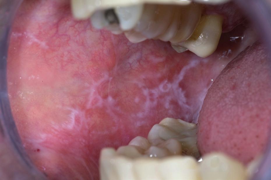 Recommendation In case of a clinical diagnosis of leukoplakia or where such diagnosis is part of the differential diagnosis the dentistgeneral practitioner is advised to look for consultation with a