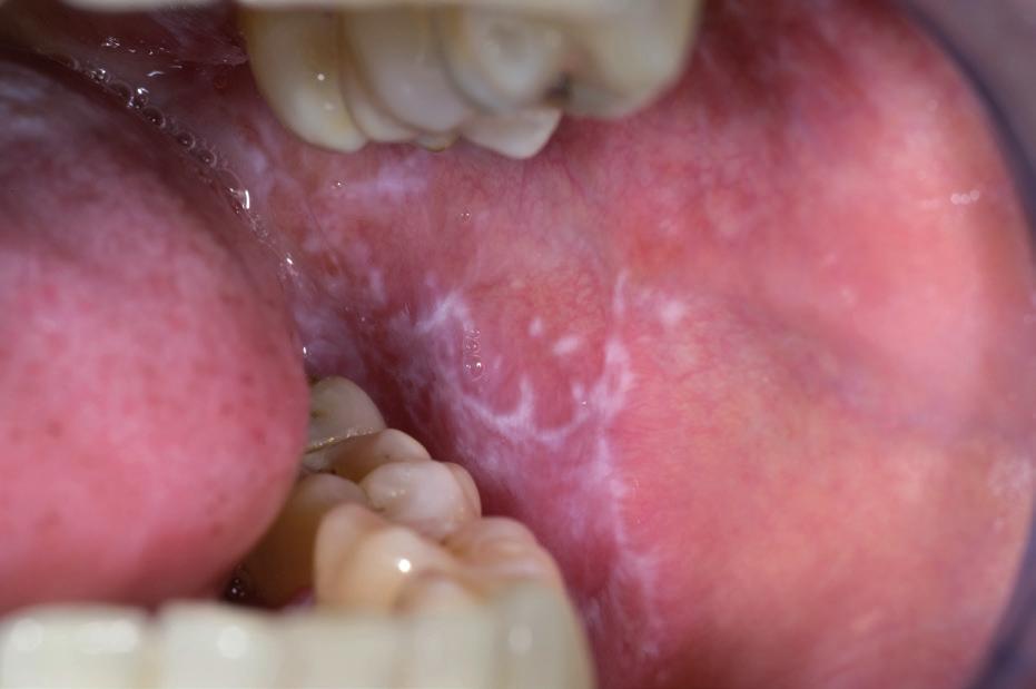 Also patient information about leukoplakia can probably better be provided by a specialist than by a general practitioner who is rarely confronted with this lesion. References 1.