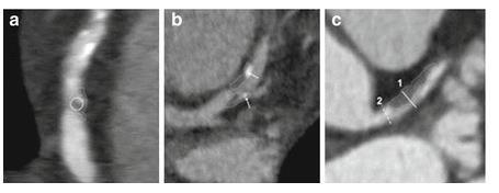 The vulnerable plaque features by CT a: Plaque with low HU (<30 HU) b: Microcalcification predicts vulnerable plaque vs heavy calcification is more stable plaque c: Positive remodeling where segment