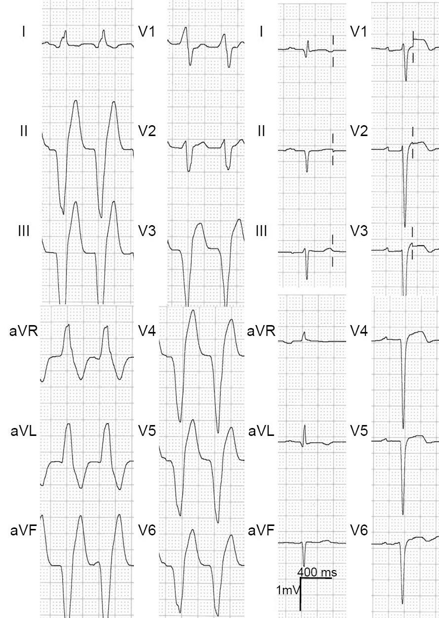 Jun Kim, et al. 633 C A B Fig. 1. Electrocardiograms and angiograms of the patient.