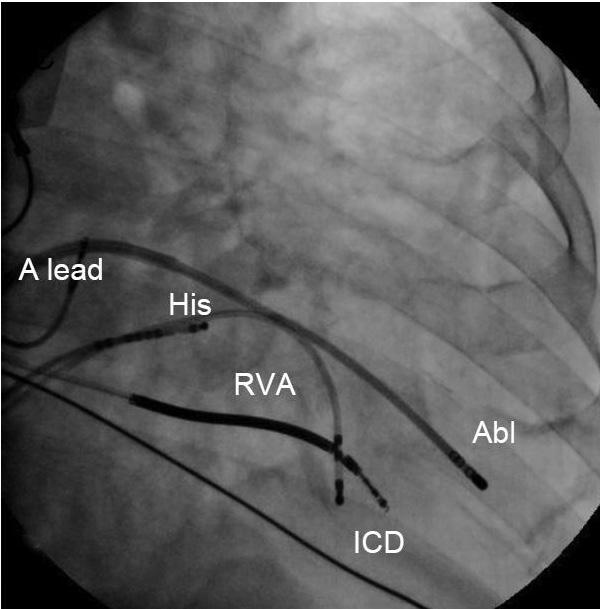 634 VT Ablation via Radial Artery B A Fig. 2. Intracardiac tracings (A) and right and left anterior oblique fluoroscopic image (B and C) mapping of the premature ventricular complex.