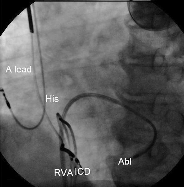 pressure are shown from top to bottom. A Purkinje-like potential, preceding QRS onset of PVC by 112 ms, is found in the left ventricular apico-inferior septum.