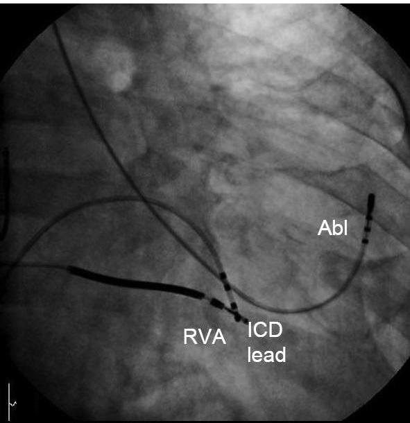 Jun Kim, et al. 635 B A Fig. 3. Intracardiac tracings (A) and right and left anterior oblique fluoroscopic images (B and C) of ventricular tachycardia ablation approached from the left radial artery.