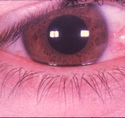 Pterygia Etiology: triangular, fibrovascular, connective tissue overgrowths of bulbar conjunctiva onto cornea; distribution of ultraviolet energy- heat, wind, dust, dry