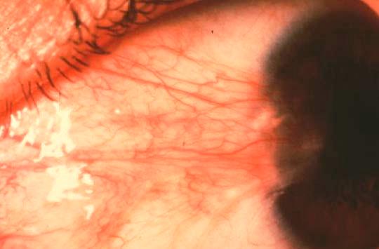 Limbal Girdle of Vogt Etiology: a