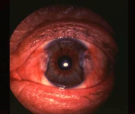 opacity in temporal and medial limbal areas