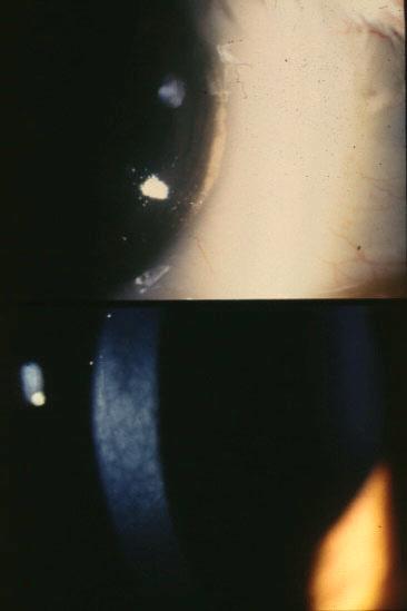 Cornea Farinata Etiology: may be transmitted as an autosomal dominant trait or may be a manifestation of senile changes Slit lamp: small gray-white, tiny, dustlike dots and