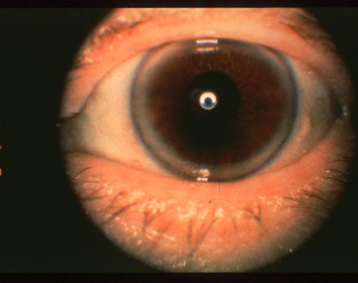 insignificant Corneal Arcus Senilus Etiology: deposition of cholesterol esters, triglycerides, and phospholipids in peripheral stromal cornea; a bilateral, hazy ring in the