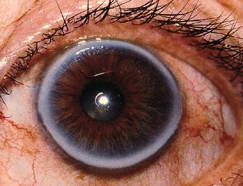 serum lipid profile), unilateral suggest vascular occlusion on side without arcus, most often age related Slit lamp: complete or incomplete perilimbal yellow-white, hazy