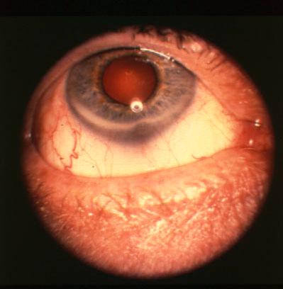 Hudson Stahli line Yellowish brown, narrow, horizontal, single line of pigmentation seen between the lower pupil margin and