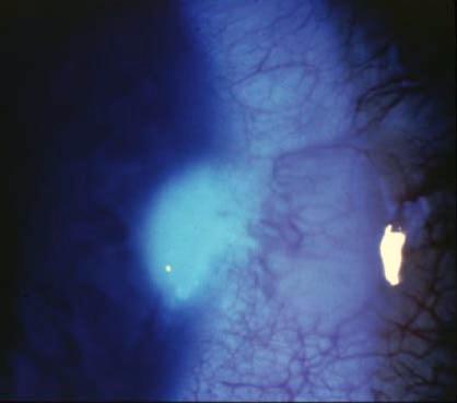 Dellen Etiology: thinning of cornea or sclera
