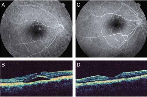 Lanzetta et al Fig. 1 - Fluorescein angiography (FA) (A) shows a focal leak of dye. Subretinal fluid is visible at optical coherence tomography (OCT) scan (B).