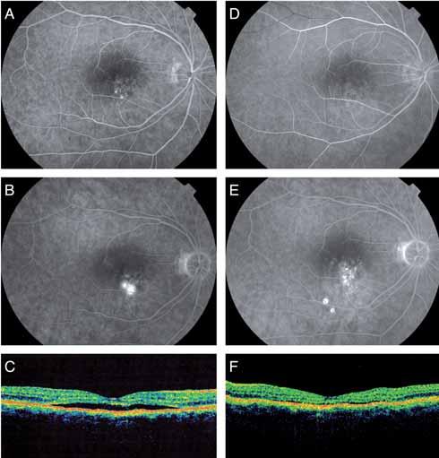 2 - Mid- (A) and late-phase (B) fluorescein angiography (FA) showing two spots of fluorescein leakage within an area of retinal pigment epithelium (RPE) mottling.