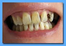Tooth whitening Dental applications - The teeth is treated by with a hydrogen peroxide- or other oxidizing