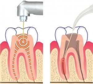 Root canal treatment Dental applications ENDODONTIC Treatments The laser disinfection complements conventional treatment.