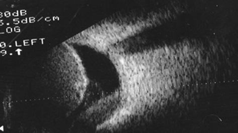Massive suprachoroidal hemorrhage Fig. 1 - B-scan ultrasonography reveals massive suprachoroidal hemorrhage with central retinal apposition. The macula is spared. Fig. 2 - B-scan echogram of a patient with massive suprachoroidal hemorrhage.