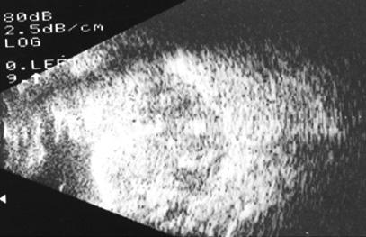 3 - B-scan ultrasonography of Patient 5 a week after drainage with radial sclerotomies. Note that the hemorrhage has been cleared from the suprachoroidal space but the retina is detached.