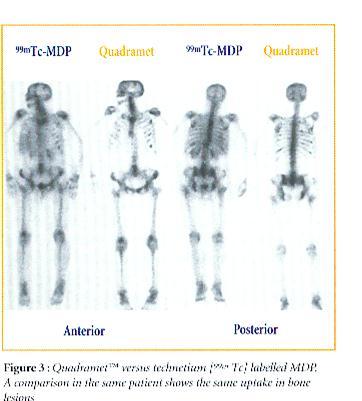 Comparison of Tc99m MDP bone