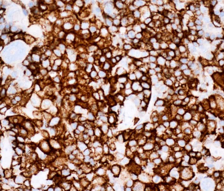 CD163+ Foamy Histiocytes PDX Bone