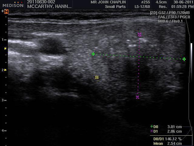 ultrasound in FNA thyroid nodule posterior nodule partially cystic multiple suspicious features
