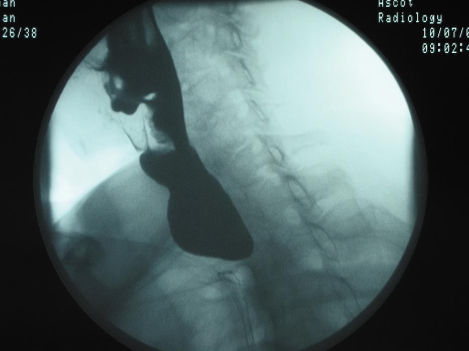 Q18 Pharyngeal Pouch (zenkers diverticulum) Outpouching of mucosa through intrinsic weak area in pharyngeal muscle (Killians