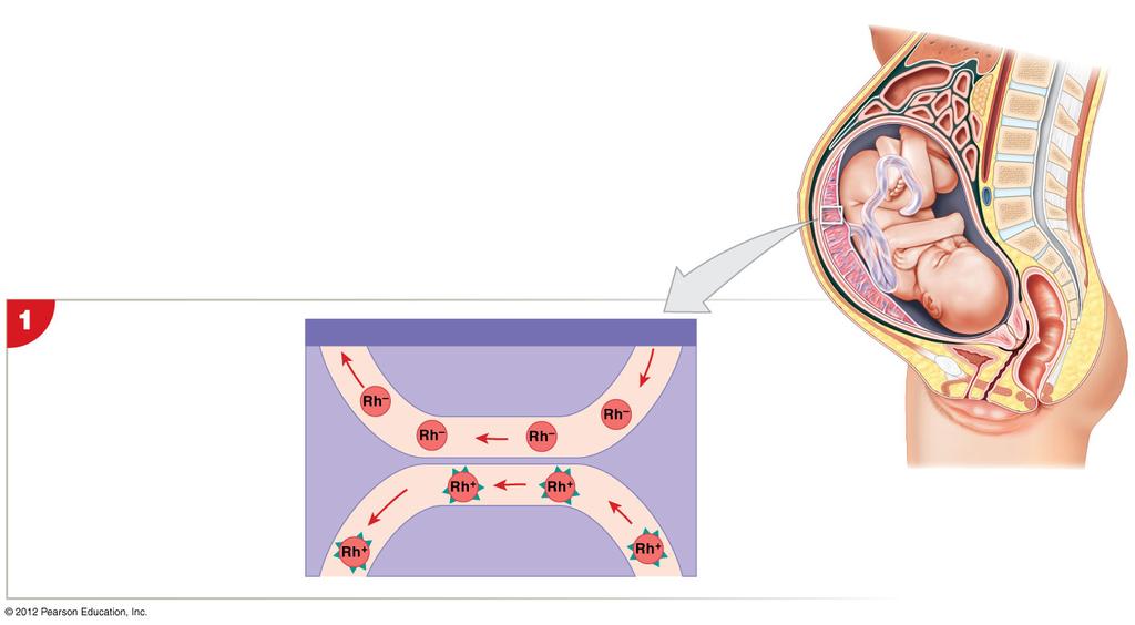 Figure 19-9 Hemolytic Disease of the Newborn Rh mother Problems seldom develop during a first pregnancy, because very few fetal cells enter the maternal circulation then, and thus the mother s immune