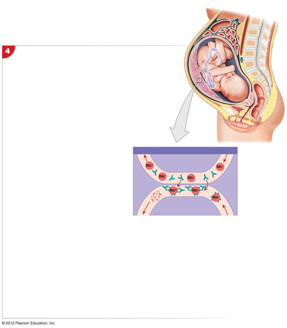 Figure 19-9 Hemolytic Disease of the Newborn Rh mother In a subsequent pregnancy, the mother is sensitized to the Rh+ fetus.