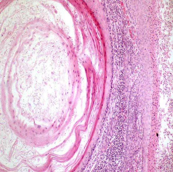 Ichthyosis Uteri Squamous cell carcinoma of endometrium Rare, < 0.