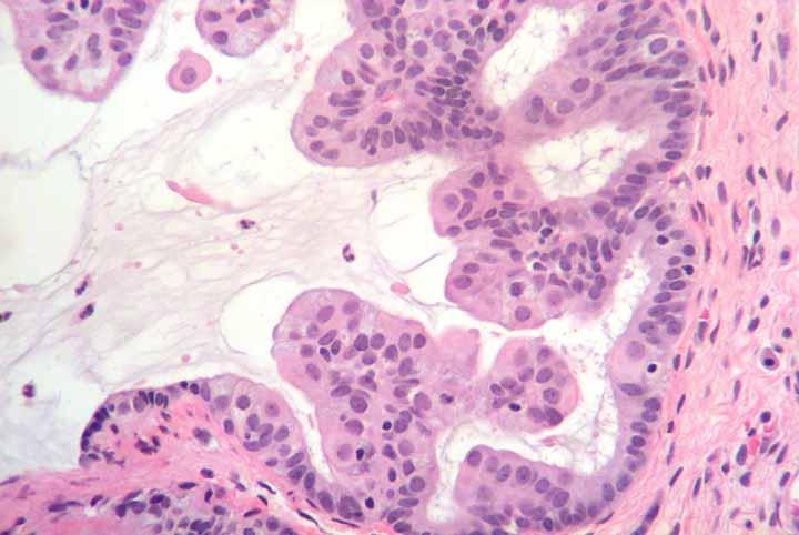 When to be concerned: Any degree of epithelial complexity associated with mucinous change The epithelial complexity can be within the gland (e.g. papillary change) OR it can be architectural complexity in disassociated strips of epithelium (e.