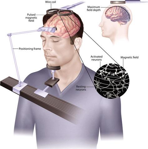 57 58 Brain Stimulation Electroconvulsive Therapy (ECT) ECT is used for severely depressed patients who do not respond