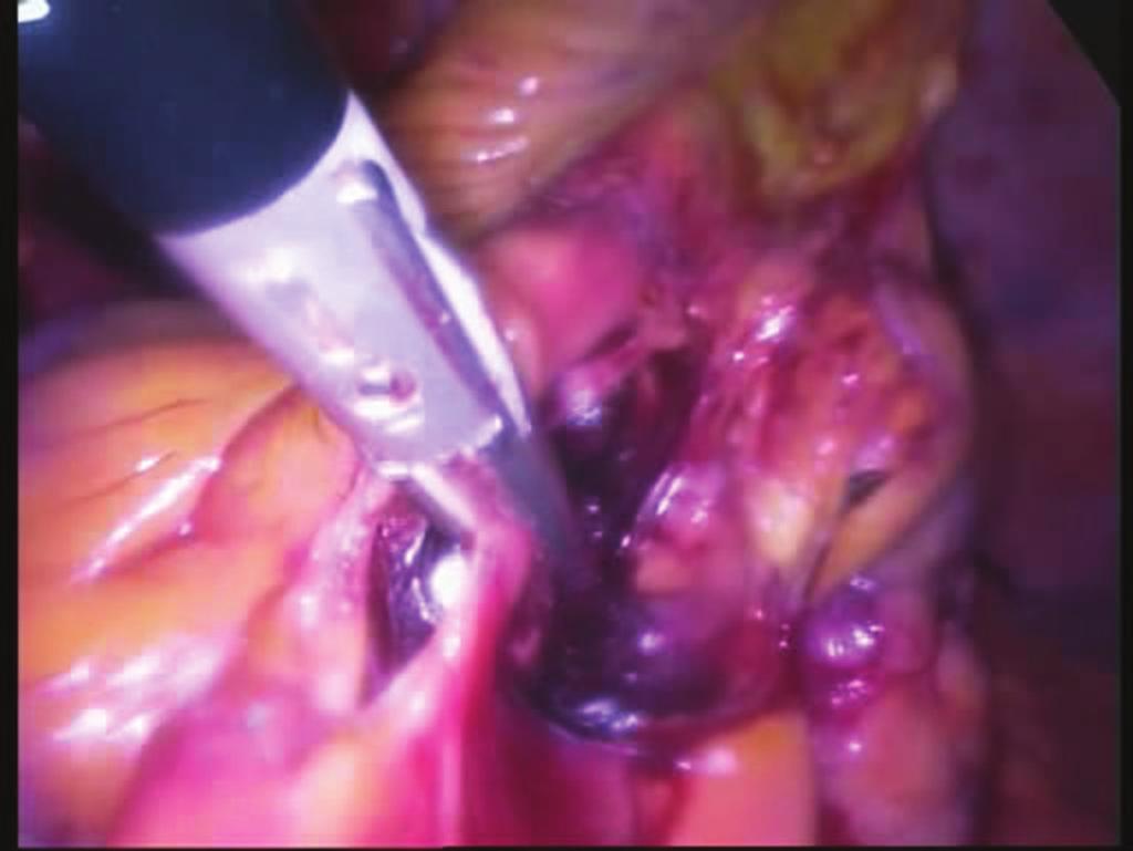 Figure 3: Medial approach for right hemicolectomy using 3 ports technique.