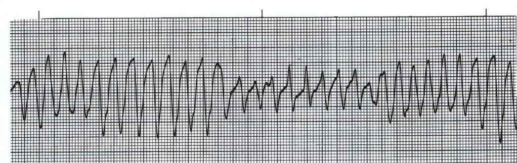 as EKG Rhythm Interpretation Exam Name: Date: ID# Unit Assume each strip is a 6 second strip. Passing is 80%. 1.