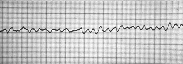 Call the Code team, defibrillate, and administer Magnesium Sulfate. C. Do nothing, this is a normal rhythm. D. Call the Code team, give atropine, prepare for pacemaker. 9.