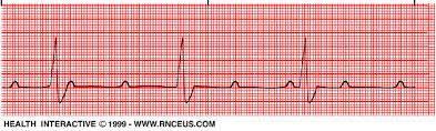 D. Call the Rapid response team (telemetry), give Atropine. 11. Identify the following rhythm: a. Mobitz I b. Complete heart block c.