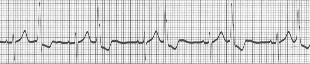 Call the rapid response team or code, prepare for pacemaker. B. Call the code, defibrillate patient. C. Administer Adenosine. D.