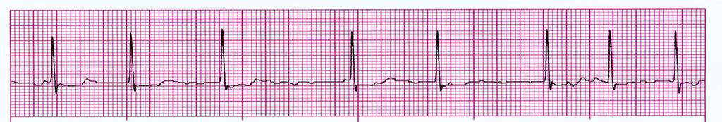 B. Assess, pt, call MD or Rapid response if hemodynamically unstable, review medications, prepare for possible Beta blocker, Ca channel blocker, Digoxin, cardioversion.