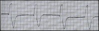 17. Identify the following rhythm: A. Sinus bradycardia B. Idioventricular rhythm C. Junctional rhythm D. Accelerated ventricular rhythm 18.