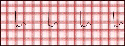 You walk in the patient s room and is unable to arouse. He has no pulse and is not breathing. His monitor shows the following rhythm.
