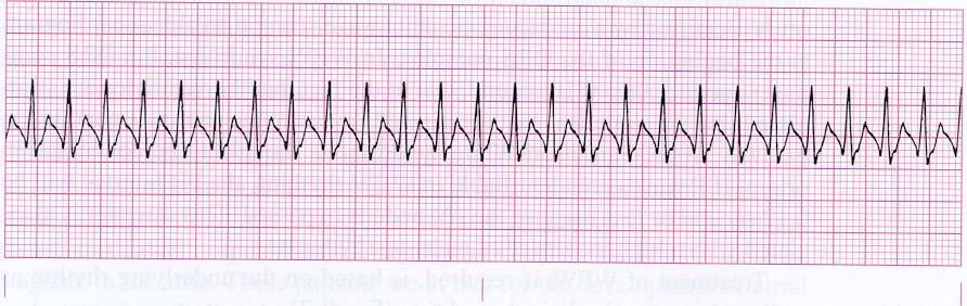20. Identify this rhythm A. Ventricular tachycardia B. Supraventricular tachycardia C. Atrial fibrillation D. Accelerated junctional rhythm 21.