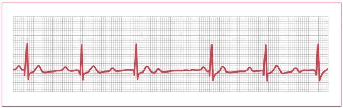 A. Sinus rhythm with premature atrial contractions B. Mobitz I C.