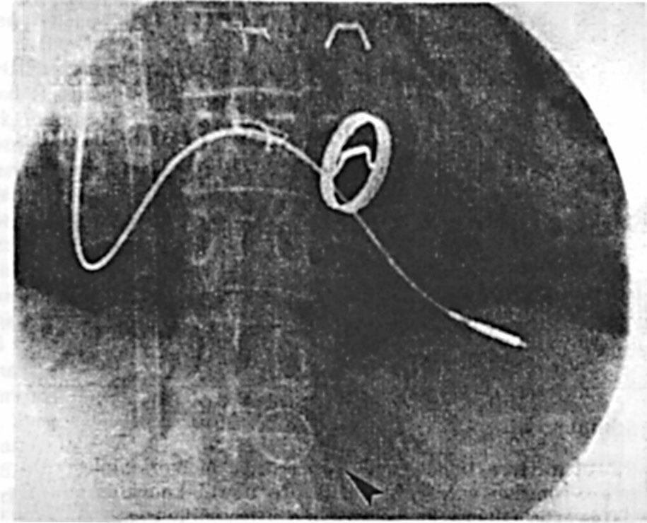 36 Chapter Two 2.2 Clinical Features A 58-year-old German woman had undergone surgery in 1974 to fix a mitral stenosis. 1 She later developed a restenosis, which caused the mitral valve to leak.