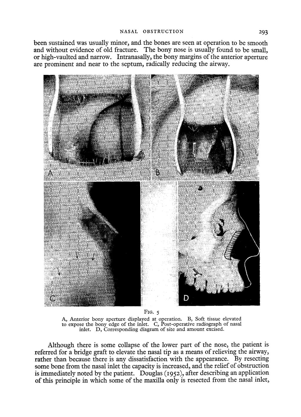 NASAL OBSTRUCTION 293 been sustained was usually minor, and the bones are seen at operation to be smooth and without evidence of old fracture.