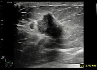 thickening An irregular shaped hypoechoic lesion with spiculated margin (sharp line radiated