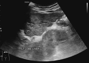 Large HCC Nodular surface, coarse echotexture of liver A well-defined